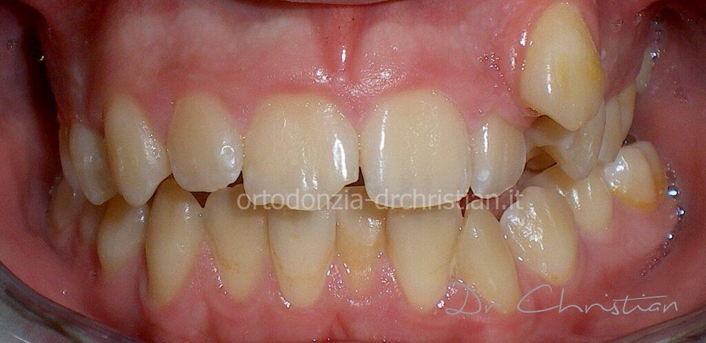 Affolamento_severo_adolescente-Prima01