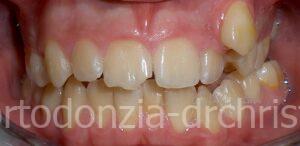 Affolamento_severo_adolescente-Prima01