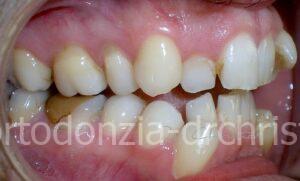 Affollamento_severo_adulto-Prima