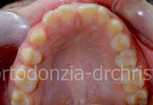Agenesia_premolari_superiori-Prima