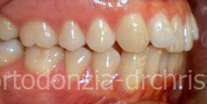 Distalizzazione_arcata_superiore_allineatori-PRIMA