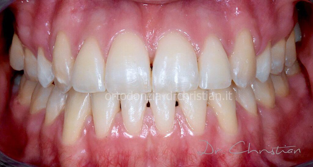 III_classe_dentale_agenesia-DOPO