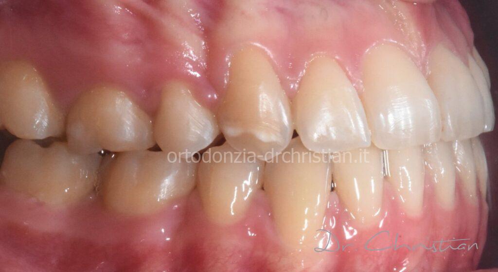 III_classe_dentale_agenesia-DOPO