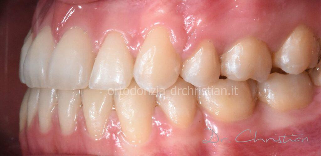 III_classe_dentale_agenesia-DOPO