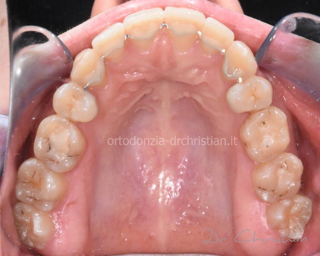 III_classe_dentale_agenesia-DOPO