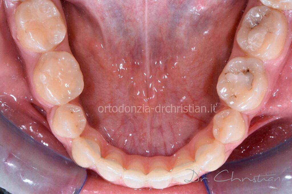 III_classe_dentale_agenesia-DOPO