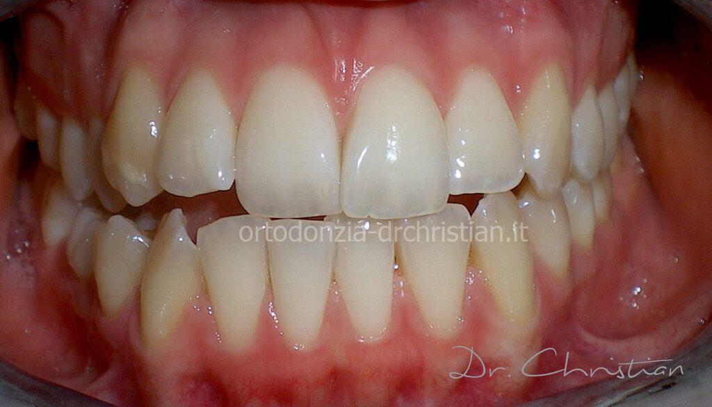 III_classe_dentale_agenesia-PRIMA