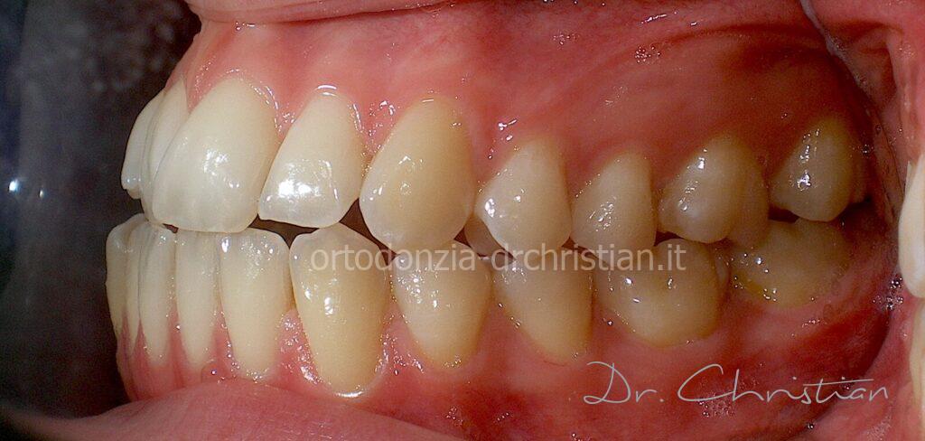 III_classe_dentale_agenesia-PRIMA