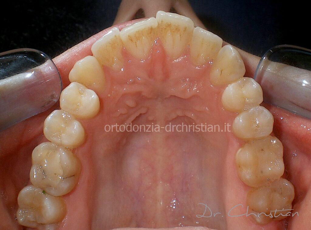 III_classe_dentale_agenesia-PRIMA