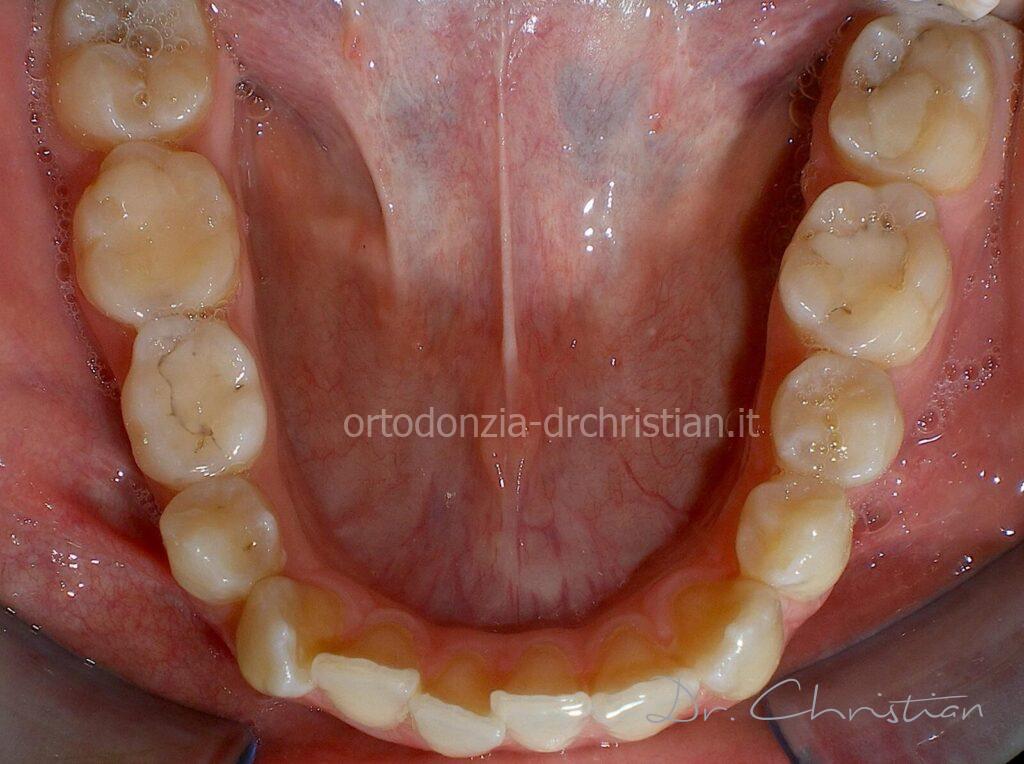 III_classe_dentale_agenesia-PRIMA