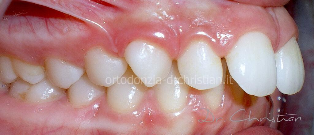 Morso_profondo_adolescente-PRIMA