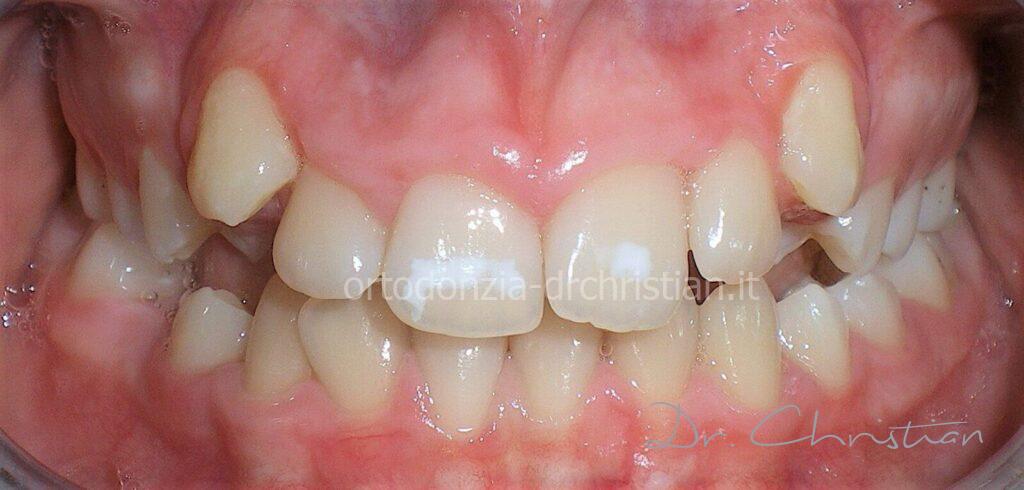 Canini ectopici viso lungo prima