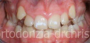 Canini ectopici viso lungo prima