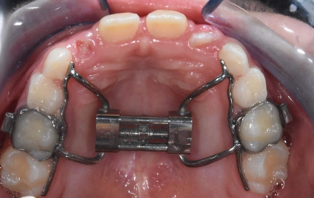 espansione rapida del mascellare