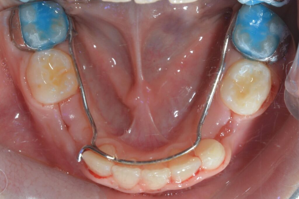 Mantenitore di spazio
